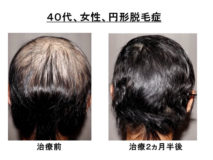 円形脱毛症　病院
